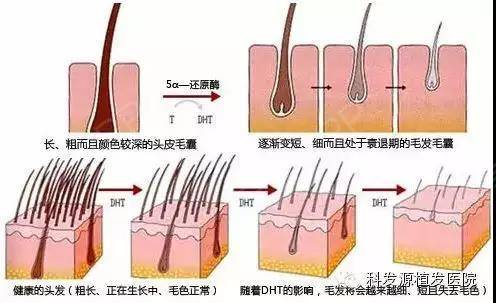 头顶短而细小长不长的毛发,是毛囊萎缩还是坏死?