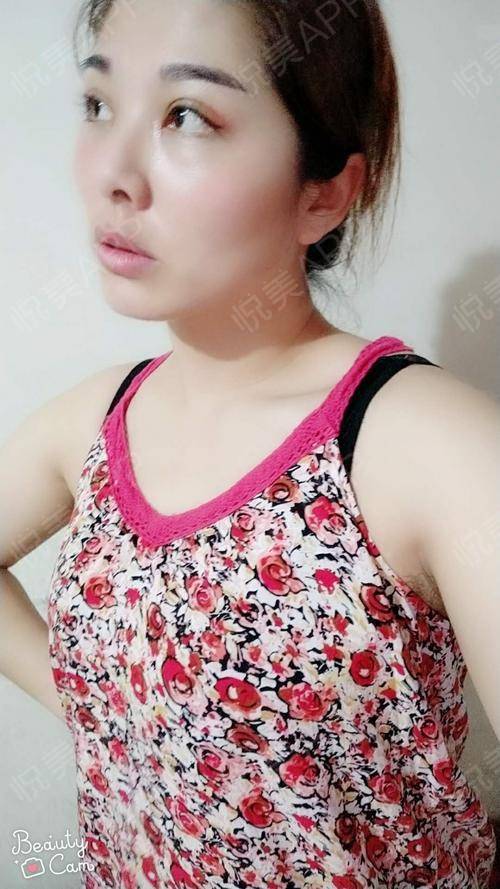 自体脂肪隆胸术后32天_乳房下垂矫正术后32天_隆胸术后32天_自体脂肪