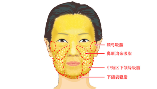 有一种大脸叫脂肪型大脸,面部吸脂了解一下!