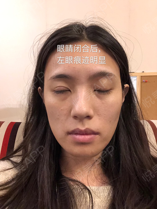 不清楚医生怎么做的,现在眼睛形态和右眼还是不一样,左眼尺寸比右眼小